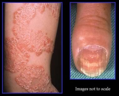 Left, typical appearance of psoriasis, with silver