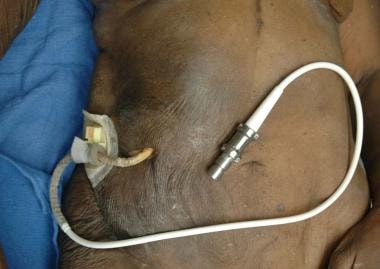An autopsy photograph of an elderly woman with an