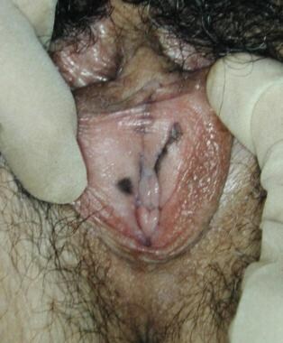 Benign vulvar lesions. Vulvar melanosis. 