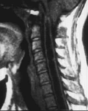 T1-weighted sagittal MRI scan demonstrates syringo
