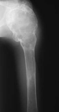 Radiograph of the humerus in a patient with primar