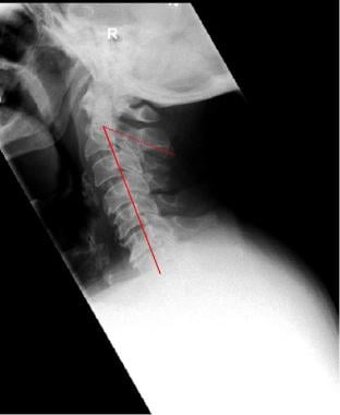 Lateral radiograph of the cervical spine shows how
