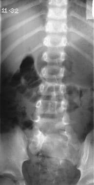 Plain anteroposterior (AP) lumbar spinal radiograp