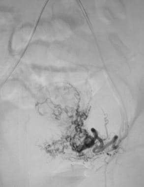 Selective angiogram of the left uterine artery pri