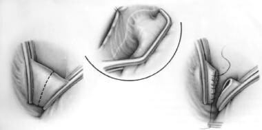 Patent Ductus Arteriosus Surgery. Division and ove