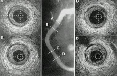 Example of intravascular ultrasonography (IVUS) im