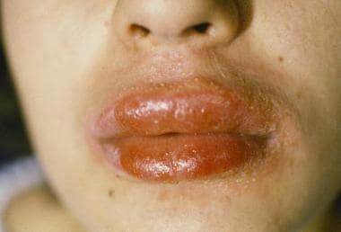 Allergic contact dermatitis involving the lips and