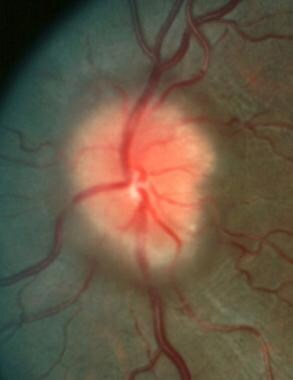 Left optic disc with moderate chronic papilledema 