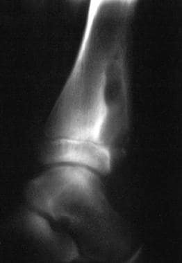 Lateral radiograph of the distal tibia. This image