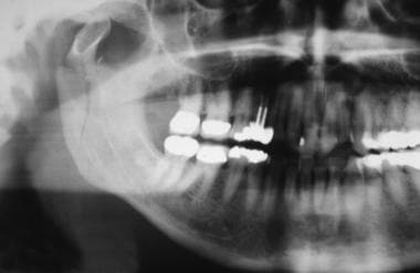 Right mandibular condylar fracture. 