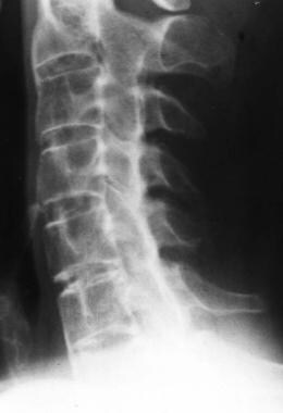 Lateral radiograph of the cervical spine shows syn