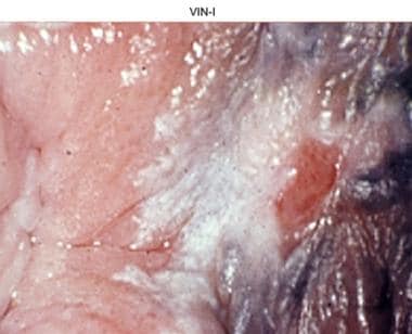 Vulval Intra-epithelial Neoplasia. Vulval problems ...