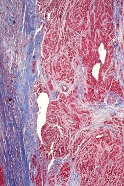 Masson trichrome stain photomicrograph of fibrolam