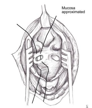 The simplest reconstruction after the laryngofissu