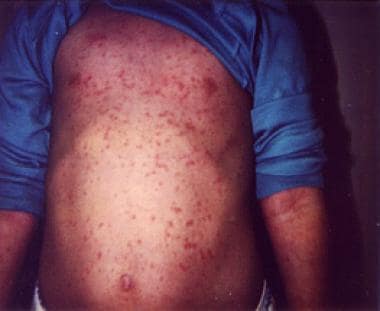 Are red spots on the skin a symptom of Rubella?