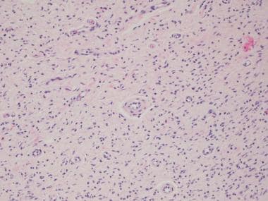 Bland wavy spindle cells in a bland fibrillary mat