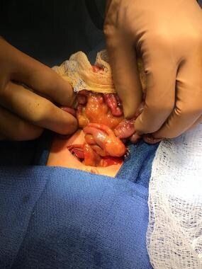 Midgut volvulus. The bowel is eviscerated and the