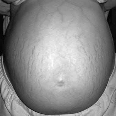 Striae distensae in pregnancy. Baby is due in less
