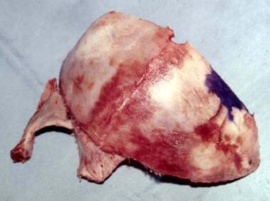 Unilateral coronal craniosynostosis. The skull is 