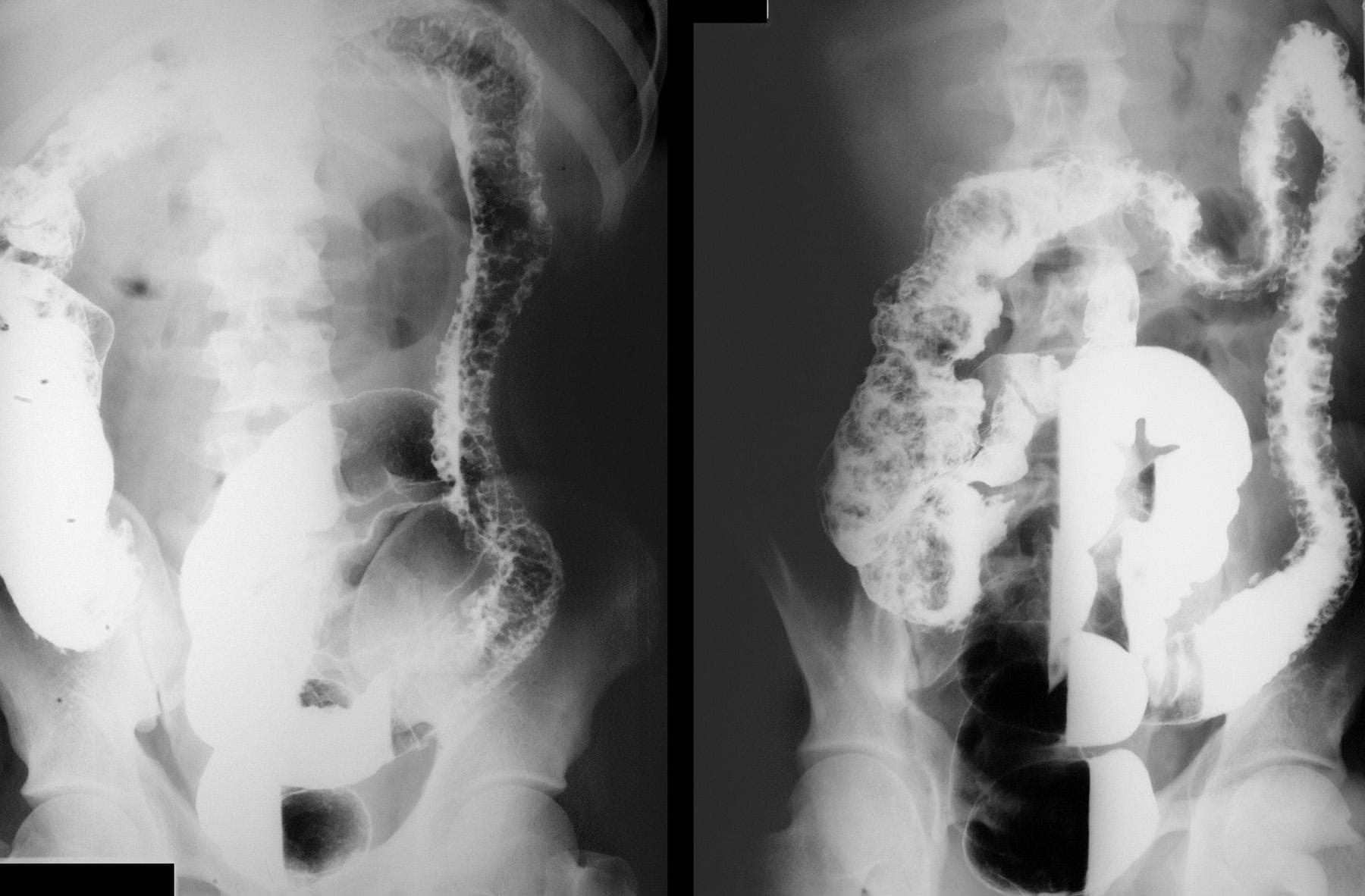 Ulcerative Colitis