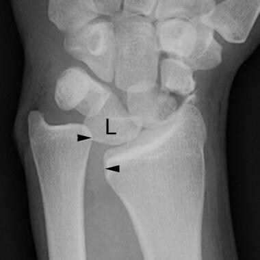 Elbow, fractures and dislocations. Anteroposterior