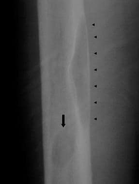 Radiograph of the mid femoral diaphysis in a patie