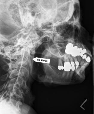 Possible false-positive radiographic finding of a 