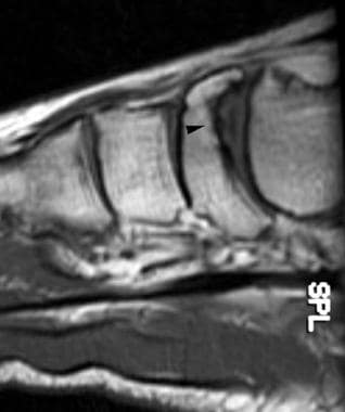 Sagittal T1-weighted image of the ankle confirms o