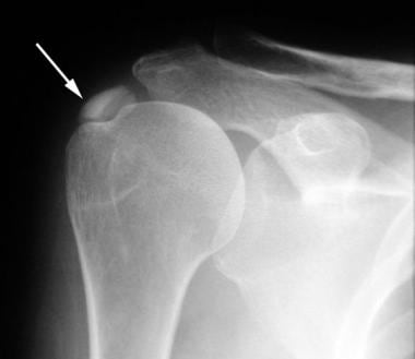 Shoulder, rotator cuff injury (ultrasonography). A