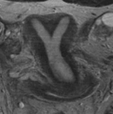Uterus, müllerian duct abnormalities. T2 fast spin