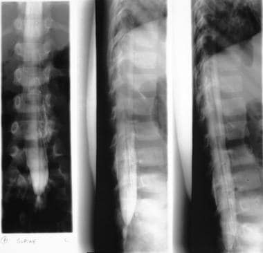 Myelograms in the same patient as in the previous 