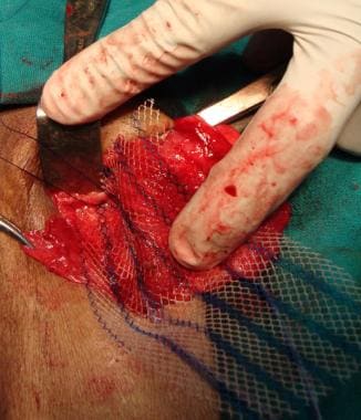 Open inguinal hernia repair. First medialmost stit
