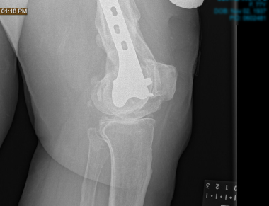Nonunion of distal femur periprosthetic fracture a
