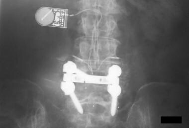 Spondylolisthesis, spondylolysis, and spondylosis 