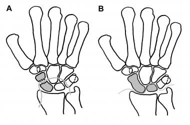 A is the greater-arc or transscaphoid perilunate d