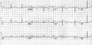 Marked prolongation of QT interval in a 15-year-ol