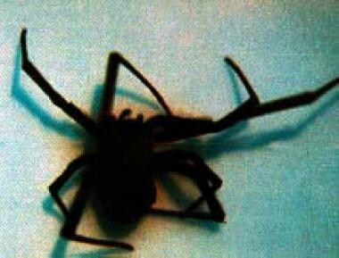 Widow Spider Envenomation: Background, Pathophysiology, Epidemiology