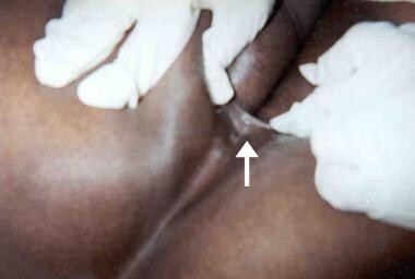 Anal Fistulas and Fissures. This patient reported 