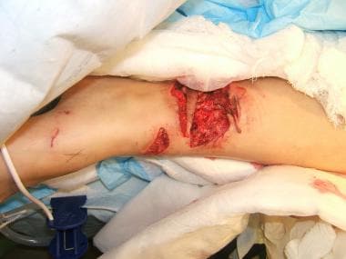 Animal bites. The devastating damage sustained by