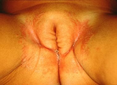 Candidal diaper dermatitis. Note satellite papules