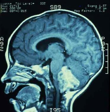 MRI showing an ependymoma of the fourth ventricle,