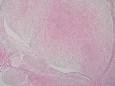 Low power appearance (20x) of the plexiform nerve