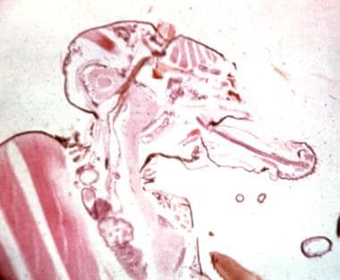 Third stage larvae of Onchocerca in the proboscis 