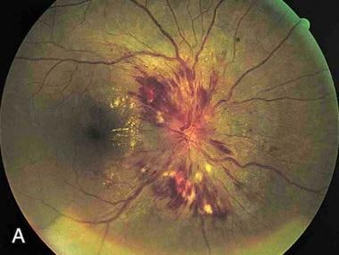 Papilledema. Note the swelling of the optic disc, 