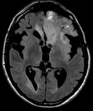 Anaplastic frontal oligodendroglioma with hemorrha