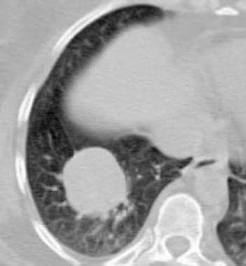 Granulomatosis with polyangiitis (GPA), thoracic. 