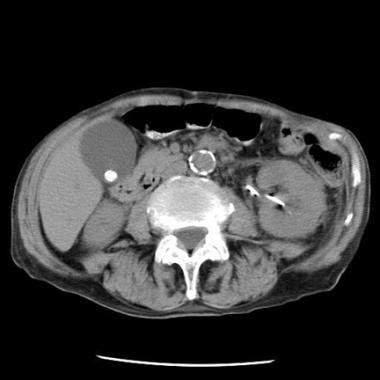 Cholelithiasis. Noncontrast CT demonstrates a typi
