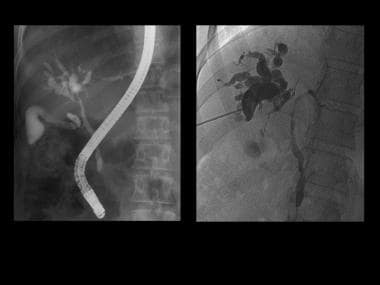 ERCP and PTC confirming the biliary abnormalities.