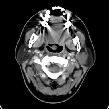 Enhanced CT image shows a lobular mass in the left