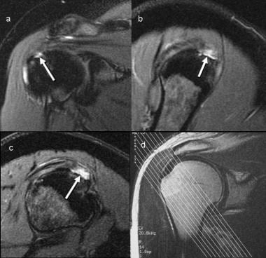 Partial-thickness tear seen better on angled obliq